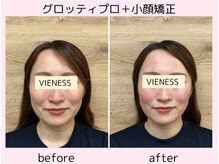 ヴィーネス(VIENESS)/【グロッティプロ＋小顔矯正】