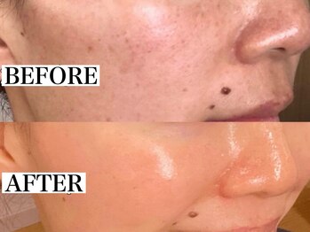 エミュ(emu)/しみさよなら