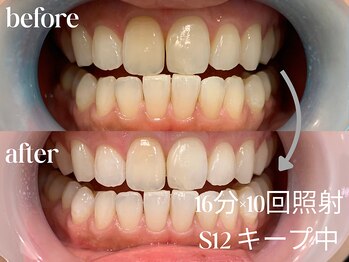 ホワイトニングカフェ 仙台八幡店/☆継続は力なり