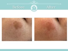 ゼロ美人 那覇店(ZERO美人)/【シミケア★シミケアZERO美人】