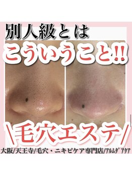 アルムダアクア 天王寺店(Aleumda AQUA)/毛穴エクストラクションプロ大阪