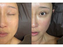 小顔矯正★プラチナフェイシャルは一度で効果を実感！