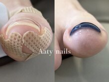 アーティネイルズ(Aaty Nails)/【巻き爪矯正】フット