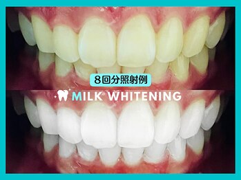 ミルクホワイトニング 長崎中央橋店(Milkホワイトニング)/★施術例