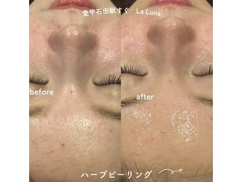 ラルーナ(LA LUNA)/ハーブピーリング