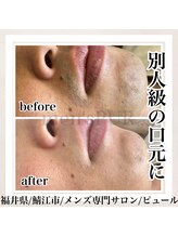ピュール 鯖江店(PUR)/【別人級の口元に】結果重視脱毛