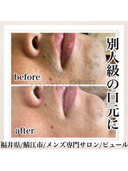 ピュール 鯖江店(PUR)/【別人級の口元に】結果重視脱毛