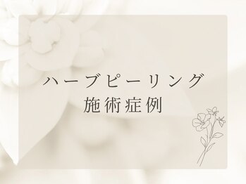 リュクス  Luxe＋tkm 南船場/ハーブピーリング