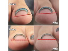 巻き爪でもネイルできる！？巻き爪矯正ジェル！ご相談ください