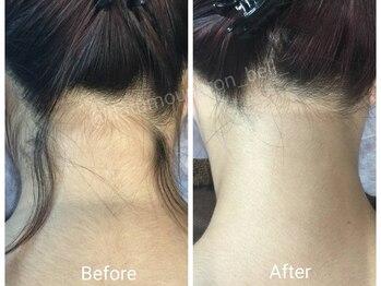 脱毛サロン ベル(Bell)/【レディース脱毛】　