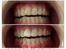 マーメイド/綺麗な歯にしましょ！