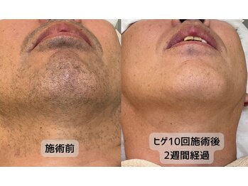 みんなのLED脱毛/男性・ひげ脱毛施術