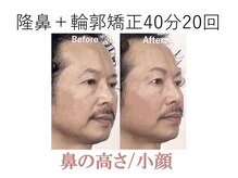ラプリシュシュ 岡山店(Raplit)/隆鼻＋輪郭矯正40分20回