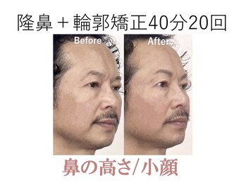 ラプリシュシュ 岡山店(Raplit)/隆鼻+輪郭矯正40分20回