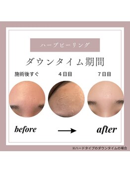 美肌ケアサロン iru 北千住店【ハーブピーリング | ララピール | 毛穴洗浄】/ハーブピーリングのダウンタイム