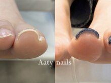 アーティネイルズ(Aaty Nails)/【巻き爪矯正】フット