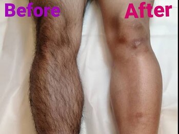 ロミオワックス ジュリエットワックス 新宿店(ROMEO Wax Juliet Wax)/1回で見違える効果!!Wax脱毛