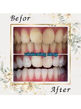 ホワイトニングショップ 宇都宮店/Before&After美白ホワイトニング