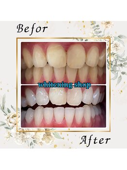 ホワイトニングショップ 宇都宮店/Before&After美白ホワイトニング