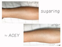 エイシー(ACEY)/ビフォーアフター☆腕