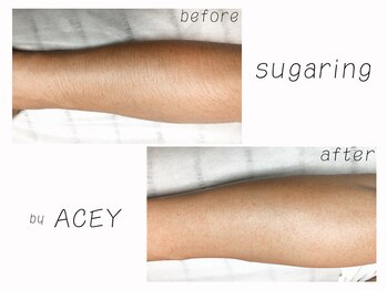 エイシー(ACEY)/ビフォーアフター☆腕