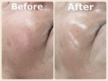 スイ 昭島店(Sui)/ハーブピーリング/ツヤ肌/韓国肌