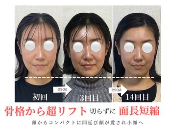 エソア(esoa)/40代 小顔矯正