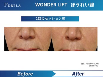 ピュアラ梅田/WONDER LIFT ほうれい線