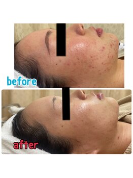 ビズビズ 天王寺店(bisebise)/ニキビ/毛穴開き黒ずみ角栓詰り