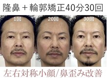 ラプリシュシュ 岡山店(Raplit)/隆鼻＋輪郭矯正40分30回