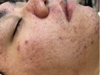 リベル 名古屋(Lebelle:)/ハーブピーリング 栄