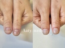 アーティネイルズ(Aaty Nails)/【深爪矯正】ハンド