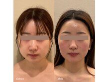 リビア(LIVIA)の雰囲気（最新マシン・オンダマイクロウェーブ☆痛みやダウンタイムなし）