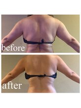 ディス イズ ミー エステティック(This is Me Aesthetic)/背中&二の腕速攻痩せ