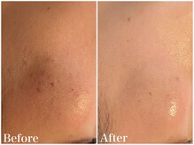 サロンドフェイス(Salon de Faith)/【ハーブピーリング】10回施術♪