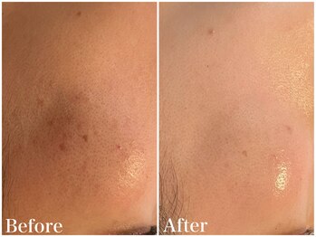 サロンドフェイス(Salon de Faith)/【ハーブピーリング】10回施術♪