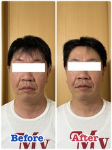 イデアル(iDeal)/男性にも人気！美容鍼ケア