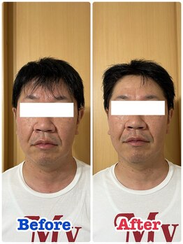 イデアル(iDeal)/男性にも人気!美容鍼ケア