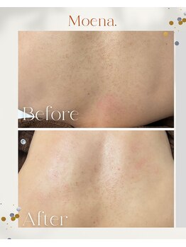 モエナ 武蔵小杉(Moena.)/背中ハーブピーリング