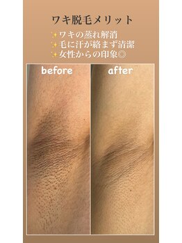 ルシャトン(Le Chaton)/ワキ脱毛