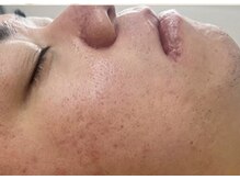 リベル 名古屋(Lebelle:)/ハーブピーリング　栄