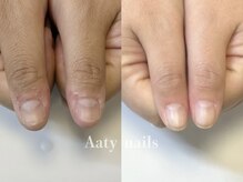 アーティネイルズ(Aaty Nails)/【深爪矯正】ハンド