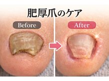 ウォーク(Walk)/肥厚爪/分厚くなった爪