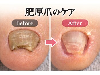 ウォーク(Walk)/肥厚爪/分厚くなった爪