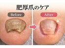 肥厚爪/分厚くなった爪
