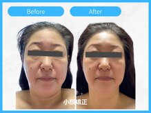 トウメイコガオ 横浜店/トウメイコガオで小顔エステ