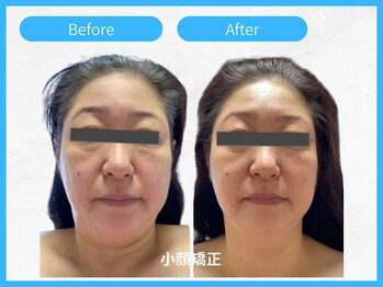 トウメイコガオ 横浜店/トウメイコガオで小顔エステ