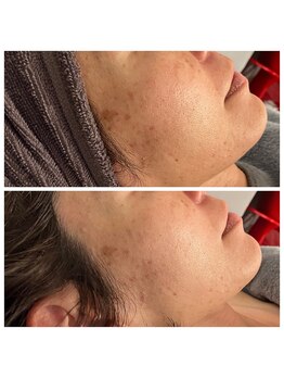 エリー(ERIE)/シミケア・美白・くすみケア