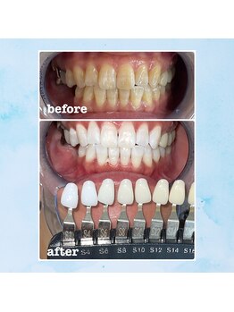 エンコロレ(encolore)/《クリスタルホワイトニング》