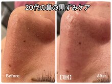 エステティック亜門の雰囲気（毛穴吸引【黒ずみ・開き毛穴ケア】吸引×ピーリング×エンビロン）